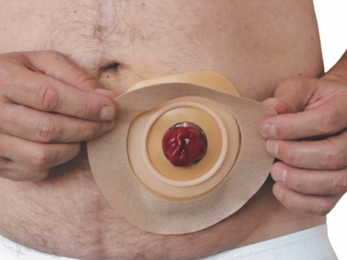 CIRCLEMATE Stomapflaster 70x120 mm beige (30 Stück)